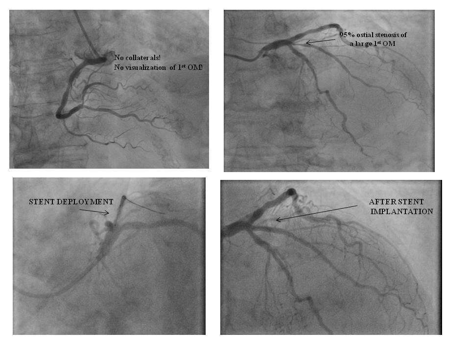 Combined 1st OM primary PCI and spontaneous trombus resolution